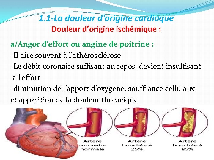 1. 1 -La douleur d'origine cardiaque Douleur d’origine ischémique : a/Angor d'effort ou angine