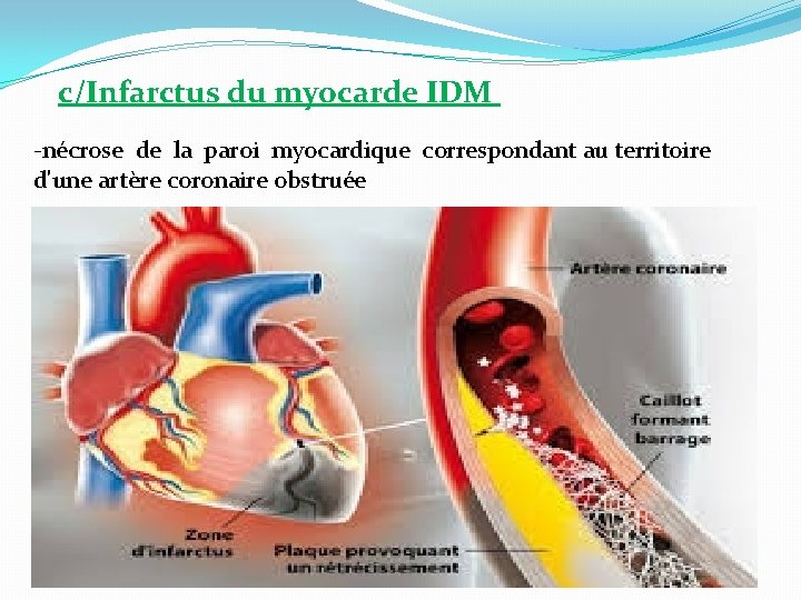 c/Infarctus du myocarde IDM -nécrose de la paroi myocardique correspondant au territoire d'une artère
