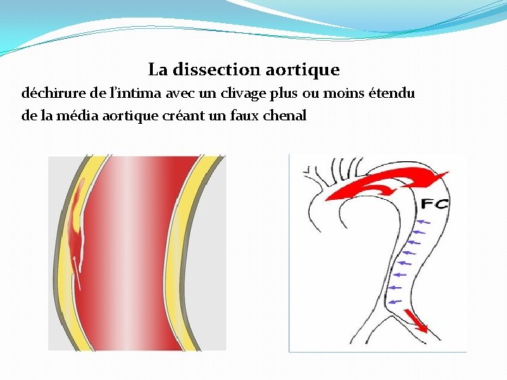La dissection aortique déchirure de l’intima avec un clivage plus ou moins étendu de