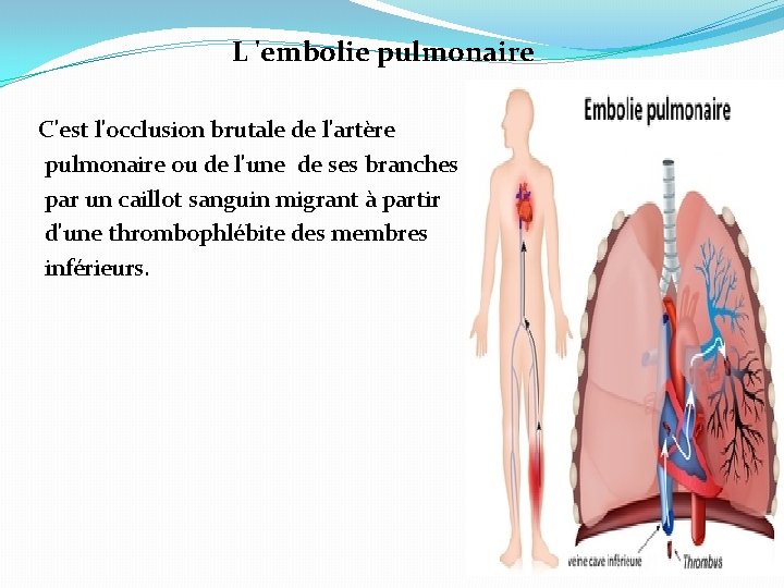 L 'embolie pulmonaire C'est l'occlusion brutale de l'artère pulmonaire ou de l'une de ses