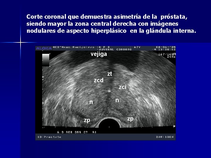 anatomia prostatica por ultrasonido)