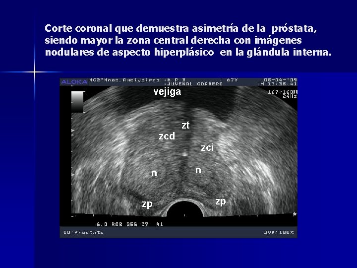 Diagnosticarea cancerului de prostată