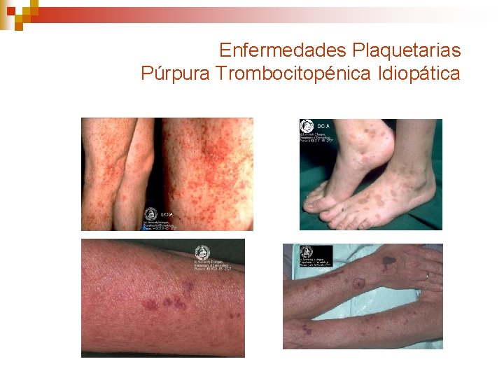 Enfermedades Plaquetarias Púrpura Trombocitopénica Idiopática 