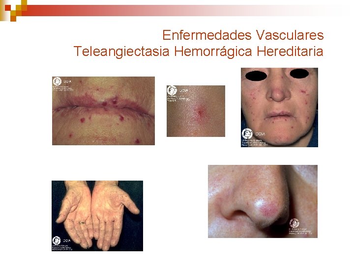 Enfermedades Vasculares Teleangiectasia Hemorrágica Hereditaria 