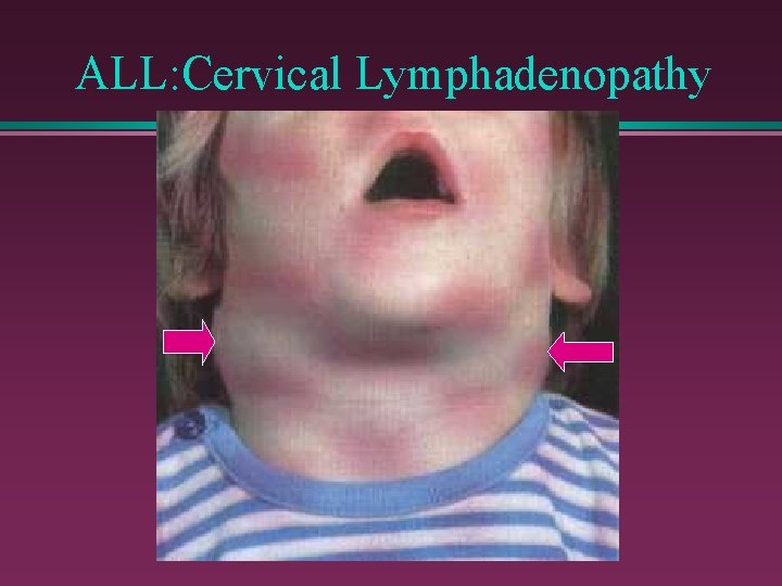 ALL: Cervical Lymphadenopathy 