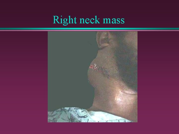 Right neck mass 