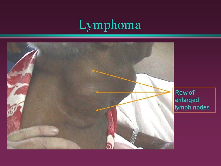 Lymphoma Row of enlarged lymph nodes 
