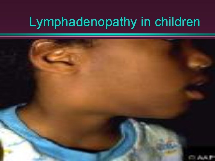 Lymphadenopathy in children 