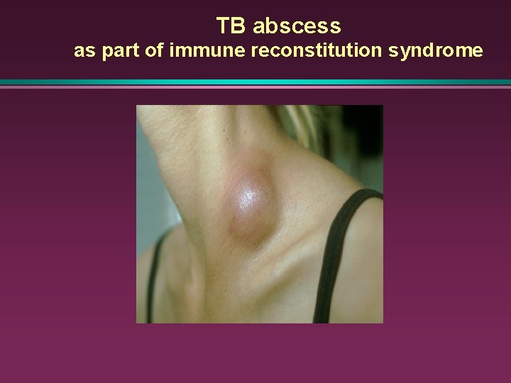 TB abscess as part of immune reconstitution syndrome 