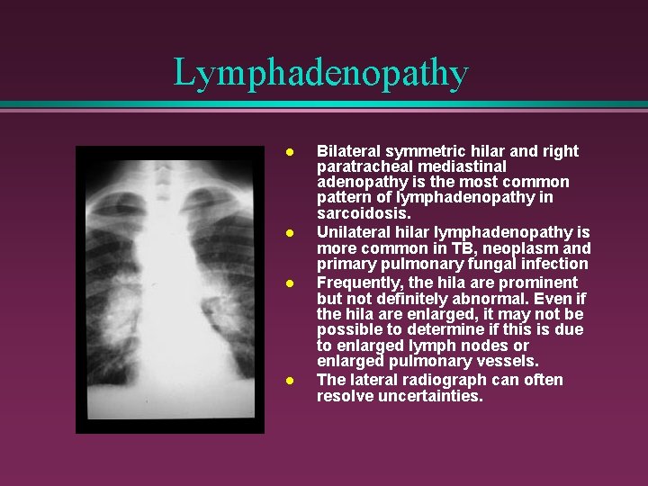 Lymphadenopathy l l Bilateral symmetric hilar and right paratracheal mediastinal adenopathy is the most