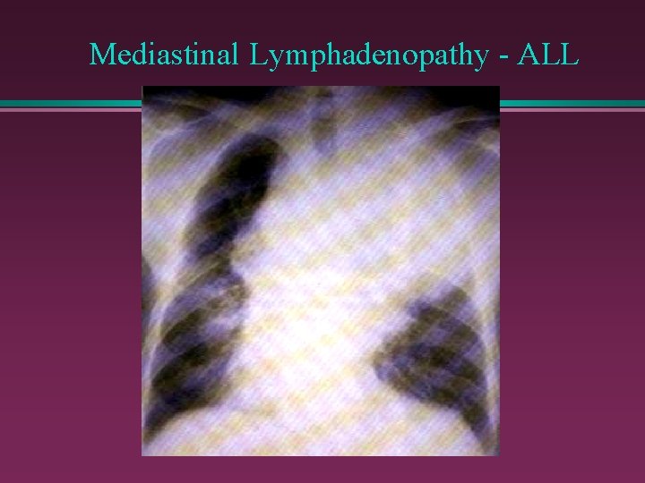 Mediastinal Lymphadenopathy - ALL 