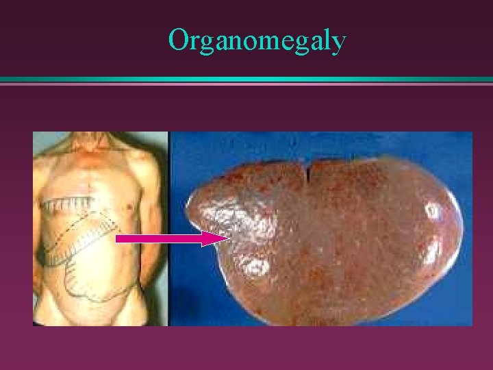 Organomegaly 