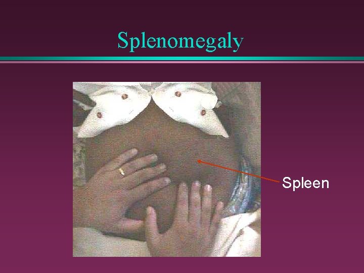 Splenomegaly Spleen 