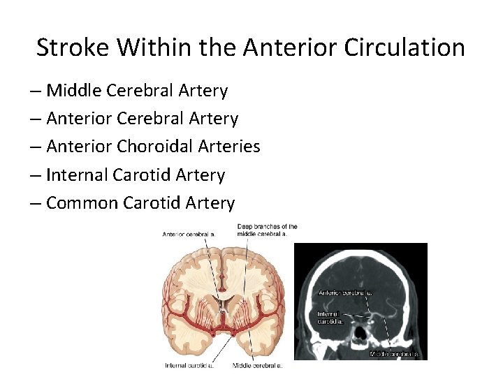 Stroke Within the Anterior Circulation – Middle Cerebral Artery – Anterior Choroidal Arteries –