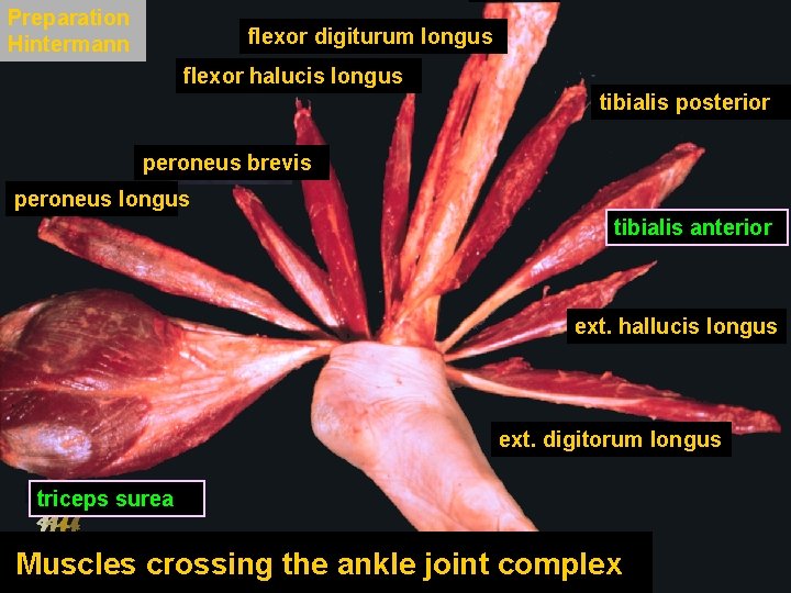 Preparation Hintermann flexor digiturum longus flexor halucis longus tibialis posterior peroneus brevis peroneus longus Preparation Hintermann flexor digiturum longus flexor halucis longus tibialis posterior peroneus brevis peroneus longus