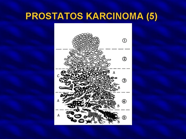 PROSTATOS KARCINOMA (5) 