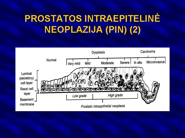 PROSTATOS INTRAEPITELINĖ NEOPLAZIJA (PIN) (2) 