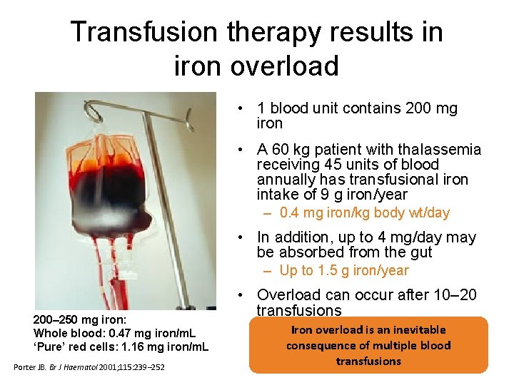 Transfusion therapy results in iron overload • 1 blood unit contains 200 mg iron