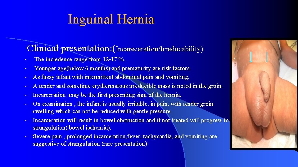 Inguinal Hernia Clinical presentation: (Incareceration/Irreducability) - - The inciedence range from 12 -17 %.