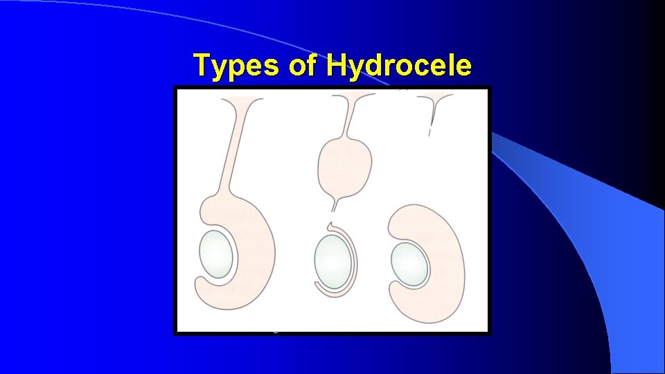 Types of Hydrocele ccommunicating 