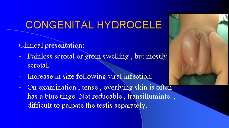 CONGENITAL HYDROCELE Clinical presentation: - Painless scrotal or groin swelling , but mostly scrotal.