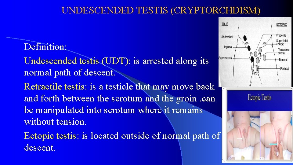 UNDESCENDED TESTIS (CRYPTORCHDISM) Definition: Undescended testis (UDT): is arrested along its normal path of