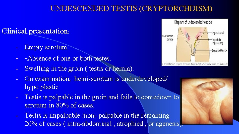 UNDESCENDED TESTIS (CRYPTORCHDISM) Clinical presentation: - Empty scrotum. - -Absence of one or both