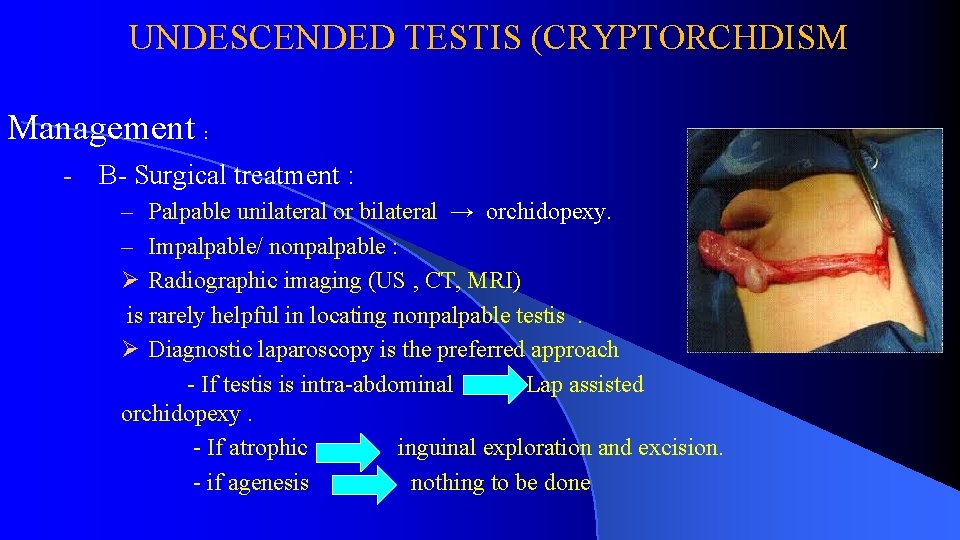 UNDESCENDED TESTIS (CRYPTORCHDISM Management : - B- Surgical treatment : – Palpable unilateral or