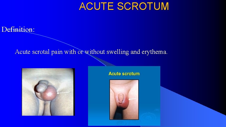 ACUTE SCROTUM Definition: Acute scrotal pain with or without swelling and erythema. 