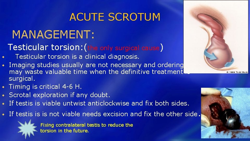 ACUTE SCROTUM MANAGEMENT: Testicular torsion: (the only surgical cause) • Testicular torsion is a