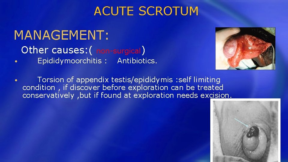 ACUTE SCROTUM MANAGEMENT: Other causes: ( • • non-surgical) Epididymoorchitis : Antibiotics. Torsion of