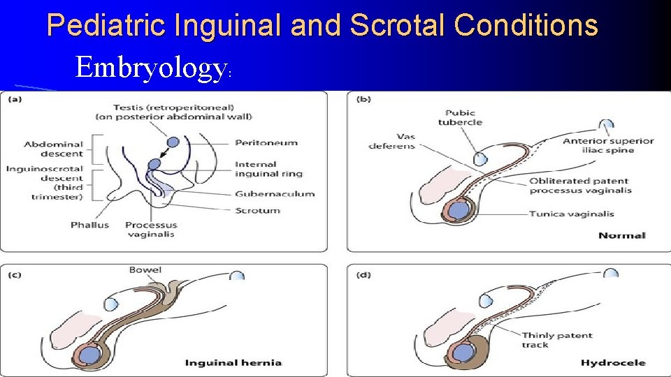 Pediatric Inguinal and Scrotal Conditions Embryology: 