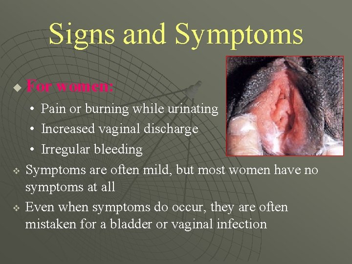 Signs and Symptoms u v v For women: • Pain or burning while urinating