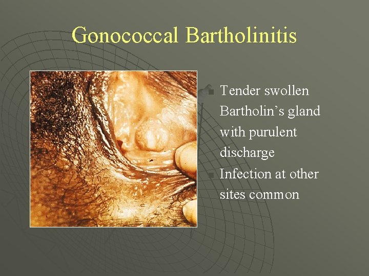 Gonococcal Bartholinitis n n Tender swollen Bartholin’s gland with purulent discharge Infection at other