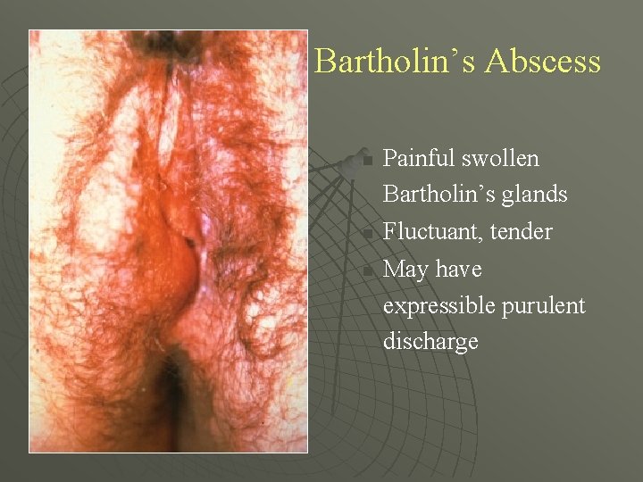 Bartholin’s Abscess n n n Painful swollen Bartholin’s glands Fluctuant, tender May have expressible
