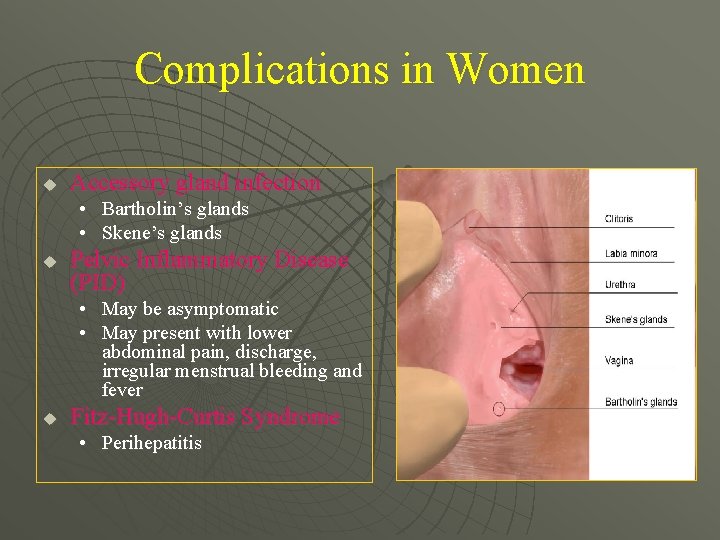 Complications in Women u Accessory gland infection • Bartholin’s glands • Skene’s glands u