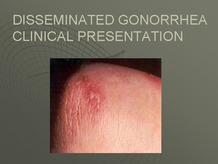 DISSEMINATED GONORRHEA CLINICAL PRESENTATION 