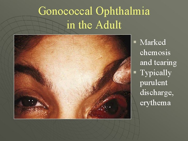 Gonococcal Ophthalmia in the Adult § Marked chemosis and tearing § Typically purulent discharge,