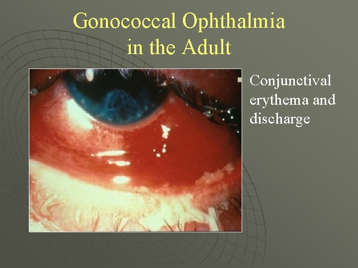 Gonococcal Ophthalmia in the Adult § Conjunctival erythema and discharge 