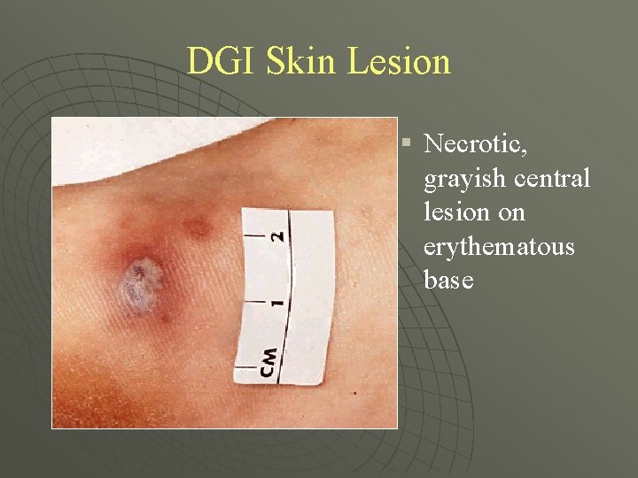 DGI Skin Lesion § Necrotic, grayish central lesion on erythematous base 
