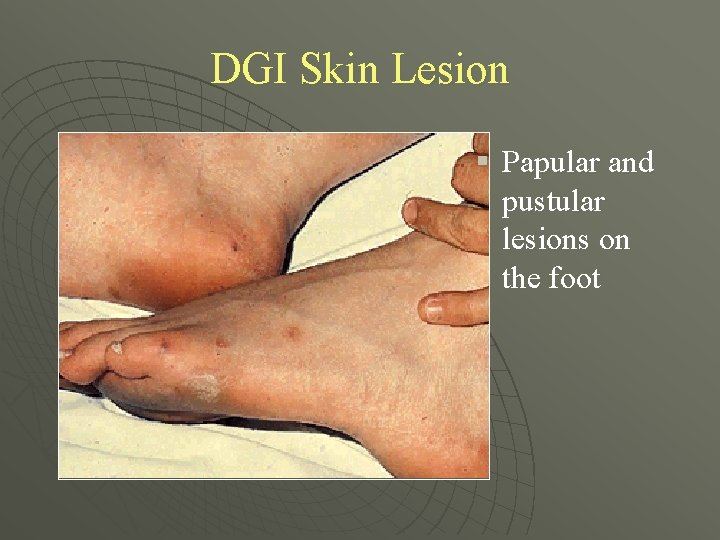 DGI Skin Lesion § Papular and pustular lesions on the foot 