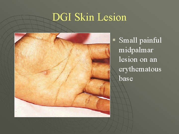 DGI Skin Lesion § Small painful midpalmar lesion on an erythematous base 