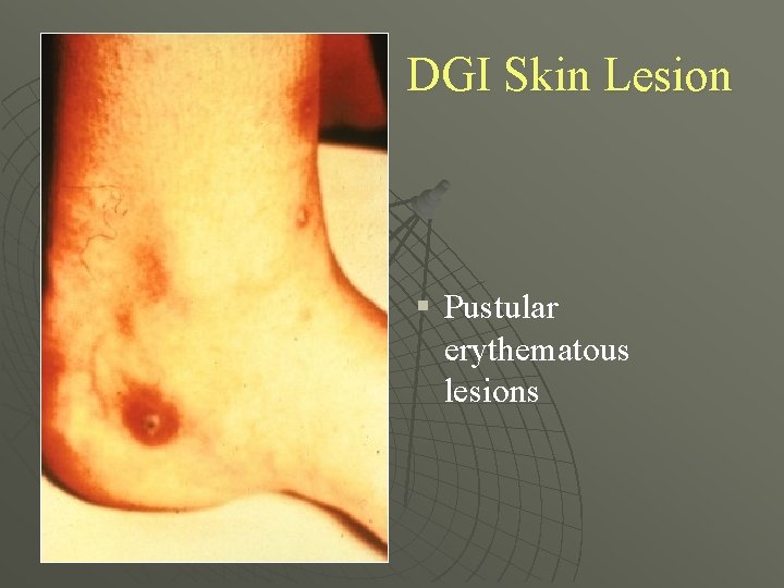 DGI Skin Lesion § Pustular erythematous lesions 