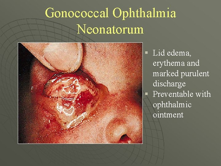 Gonococcal Ophthalmia Neonatorum § Lid edema, erythema and marked purulent discharge § Preventable with