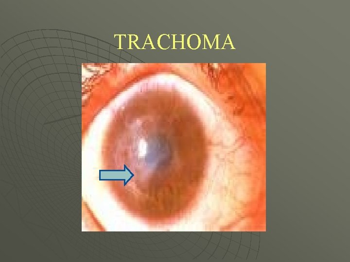 TRACHOMA 