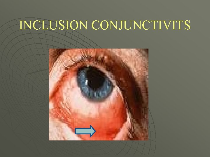 INCLUSION CONJUNCTIVITS 