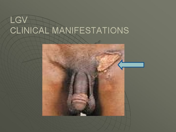 LGV CLINICAL MANIFESTATIONS 