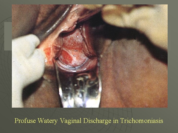 Profuse Watery Vaginal Discharge in Trichomoniasis 