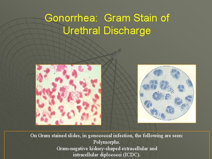 Gonorrhea: Gram Stain of Urethral Discharge On Gram stained slides, in gonococcal infection, the