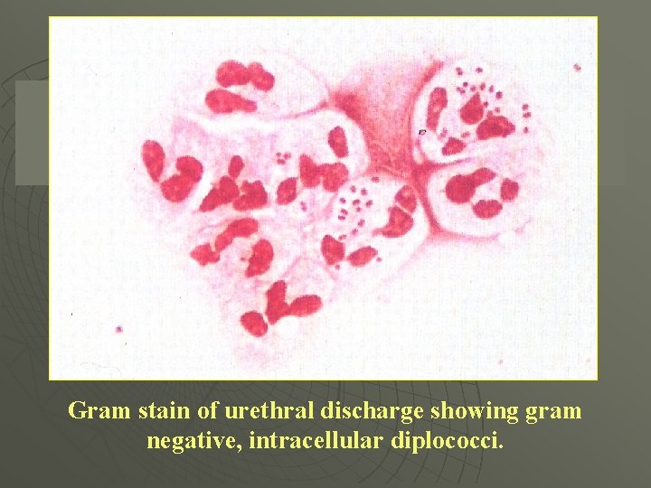 Gram stain of urethral discharge showing gram negative, intracellular diplococci. 
